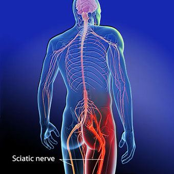 Relieve Sciatica Pain Naturally