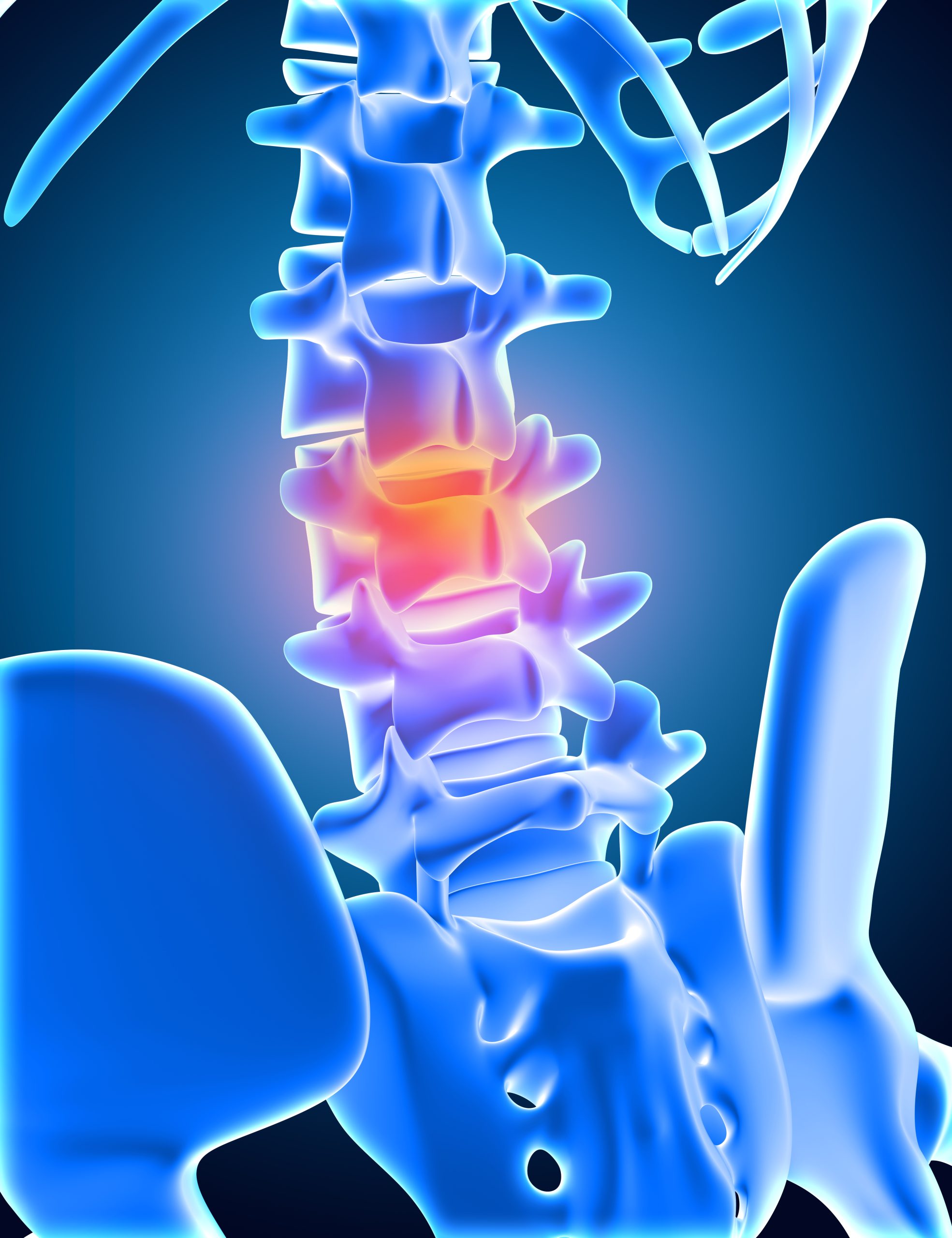 Herniated Disc vs. Sciatica Pain What's the Difference